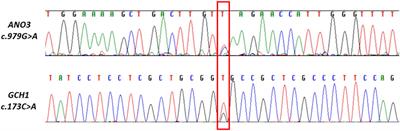 Effort to differentiate essential tremor plus and dystonic tremor using whole exome sequencing: an exploratory study